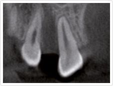 Zahnlücke ohne Implantat